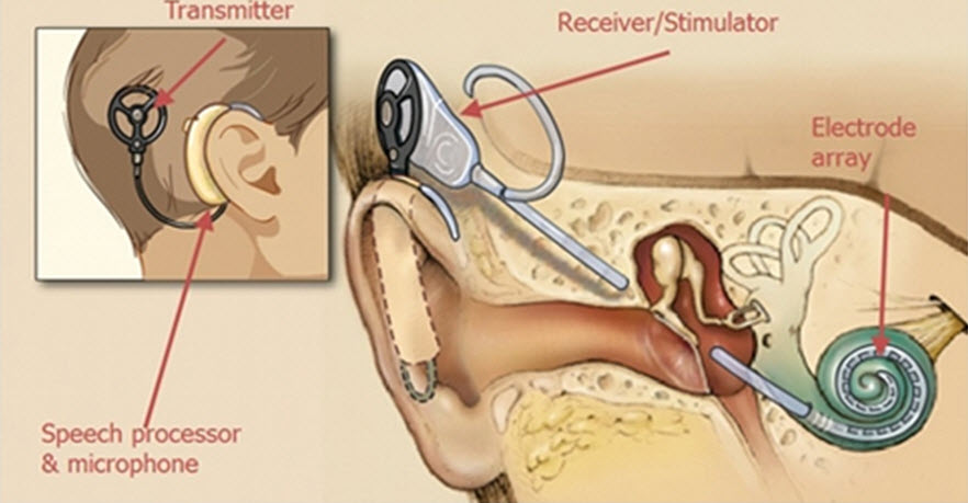 Auditory brainstem implant