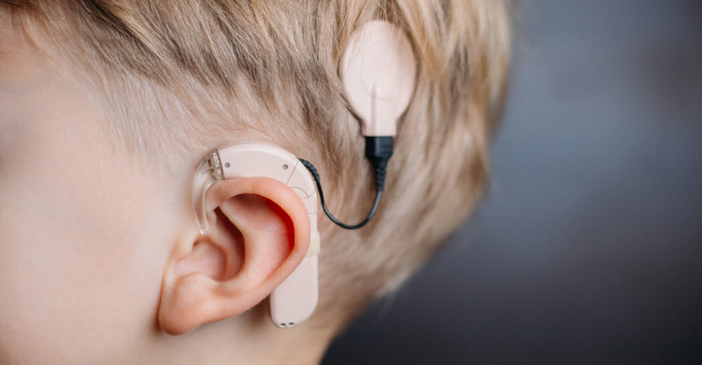 Cochlear implant