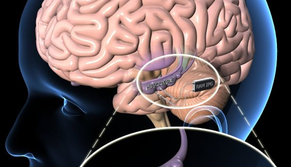 Hippocampal prosthesis